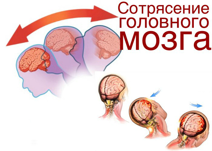 Реабилитация и лечение при травмах головного мозга (ЧМТ)